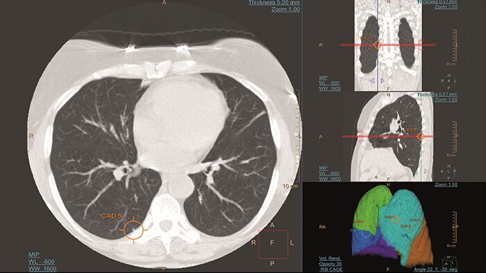 lung nodule cad thumbnail