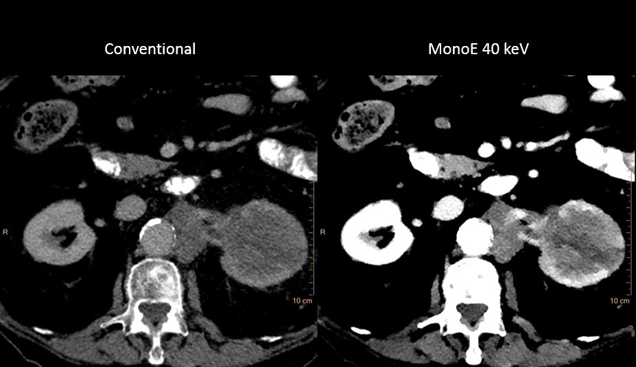 Conventional Scan Vs MonoE download image