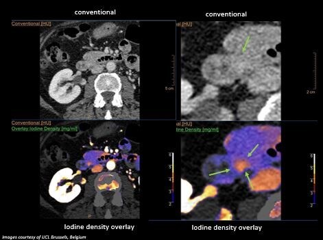 Spectral CT download image