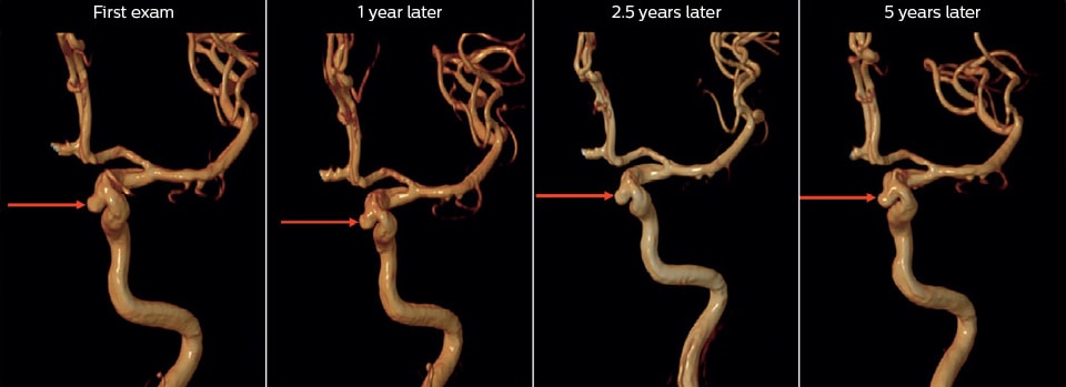 5years mra followup of unruptured aneurysm