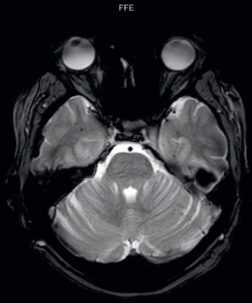 UVM case 1 FFE hemosiderin foci in brain1