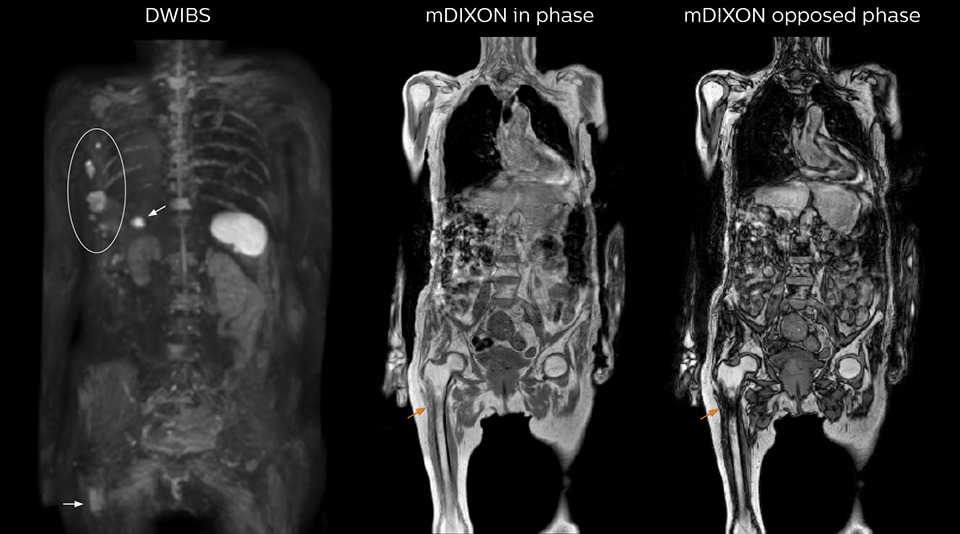 dwibs metastasized breast cancer