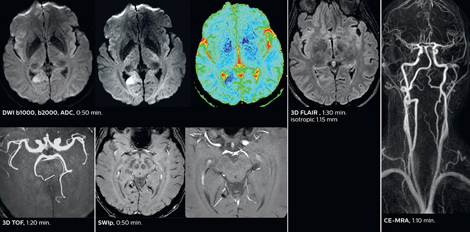 Fast acute stroke protocol