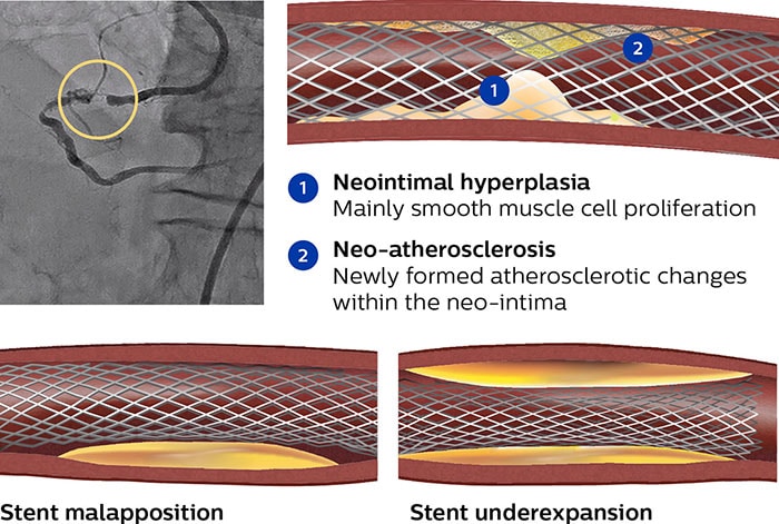 Stent oveview chart