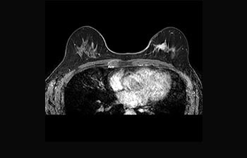 Breast lesion