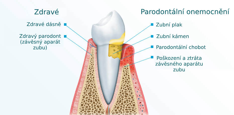 Periodontal Disease